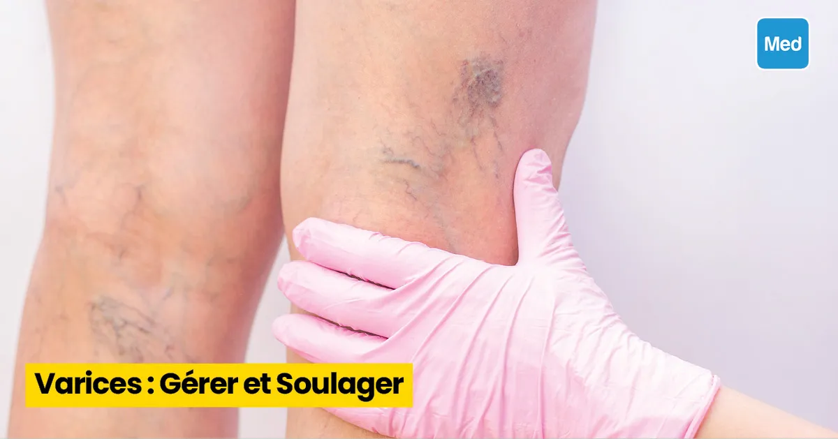 Varices : Gérer et Soulager